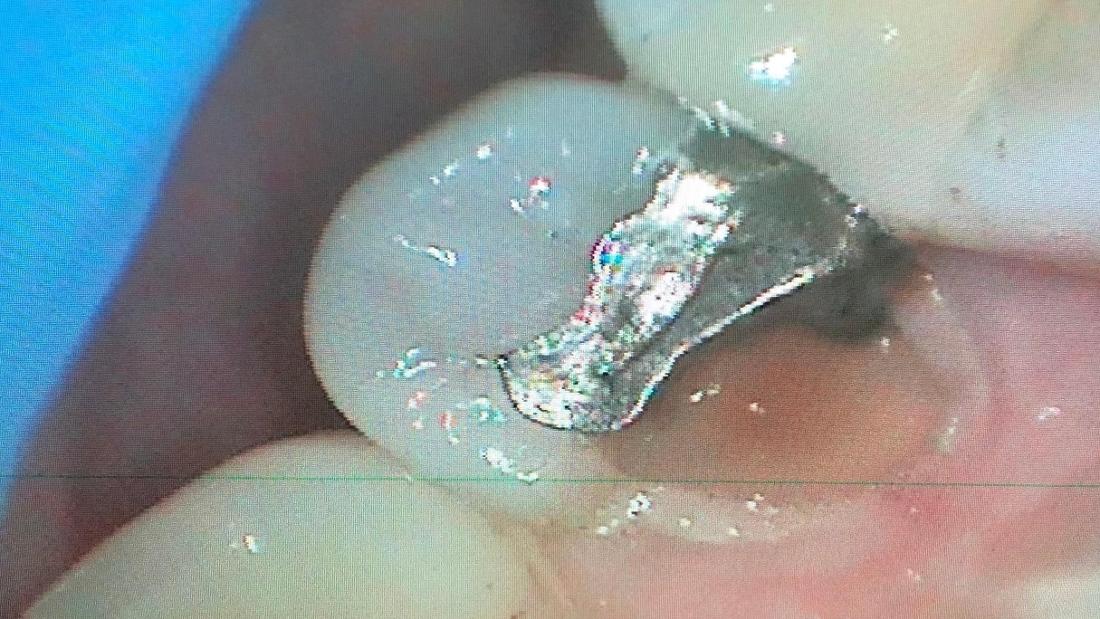 Why Can't I Just Get a Filling? Dental Crowns vs Fillings