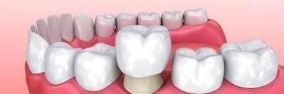 Dental crown being put on a tooth, glendale ca