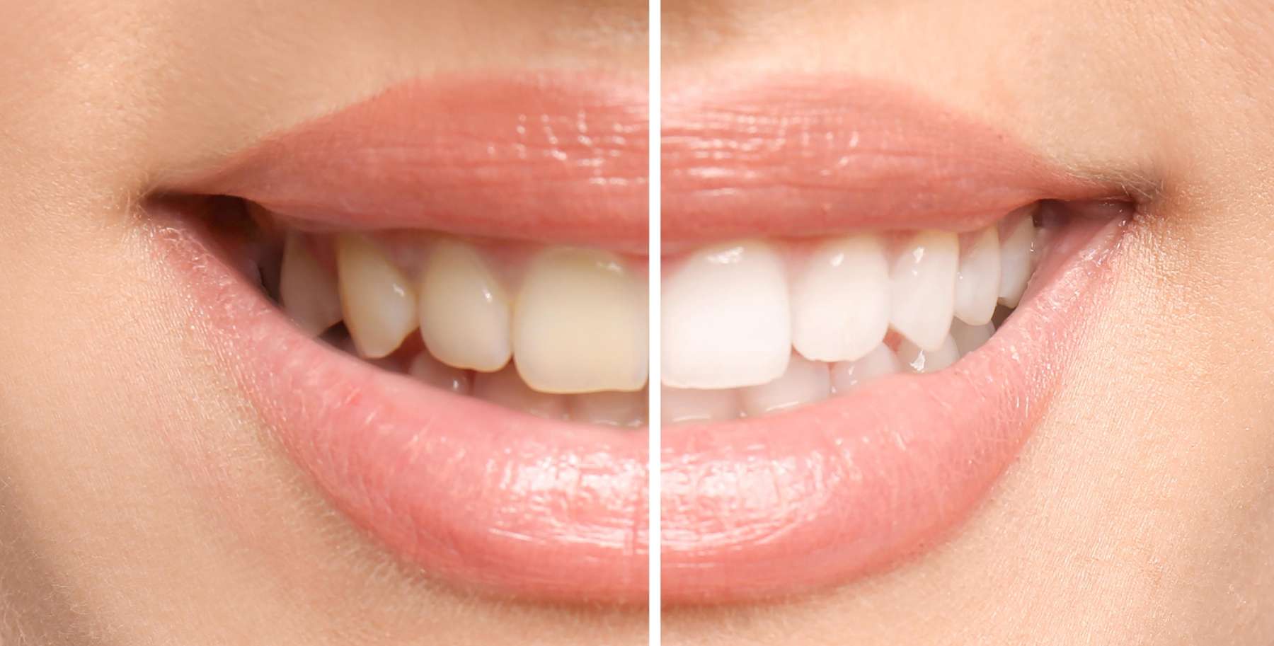 Befor and After Tooth Cleaning Result