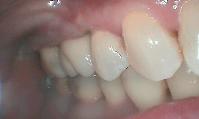 Gum Recession Treatment in Glendale