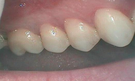 after Gum Recession Treatment in Glendale