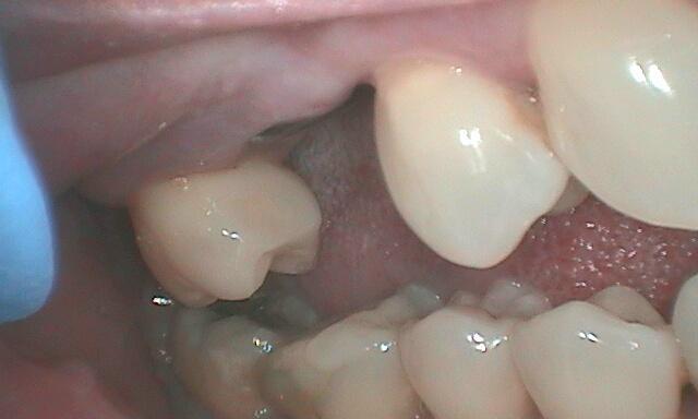 Gum Recession Treatment in Glendale