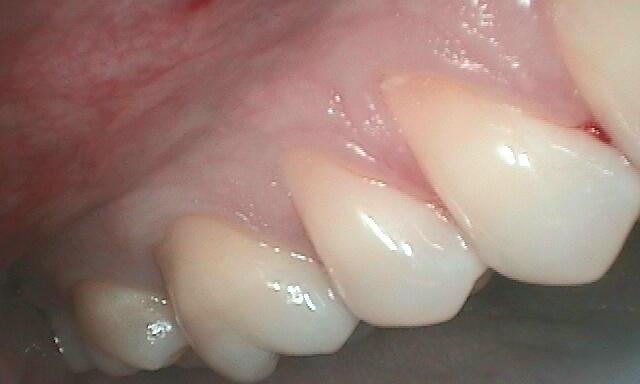 before Gum Recession Treatment in Glendale