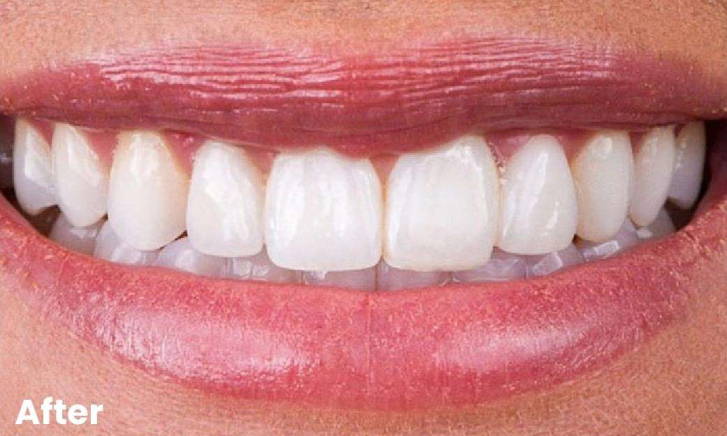 Close up of womans smile after crowns and bridges, glendale ca