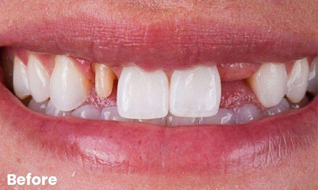Close up of womans smile before crowns and bridges, glendale ca