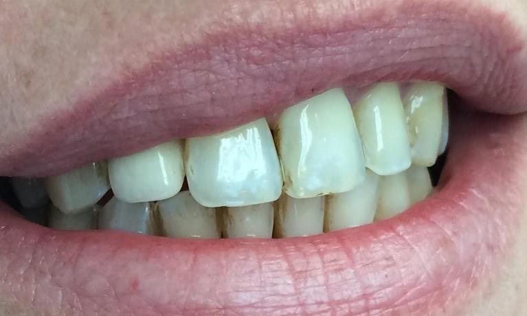 Dental-Implant-Results-After-Image