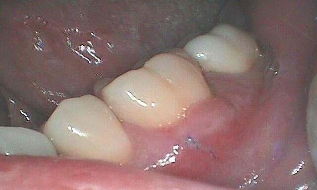 Gum-Recession-Treatment-After-Image