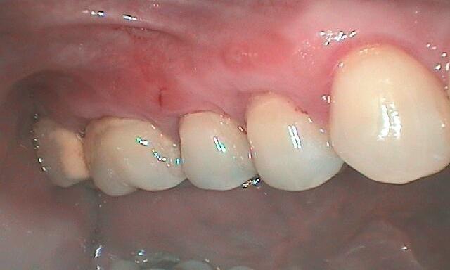 after Gum Recession Treatment in Glendale