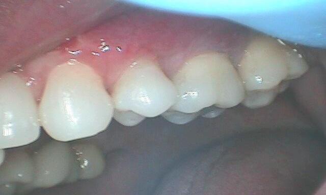Gum Recession Treatment in Glendale