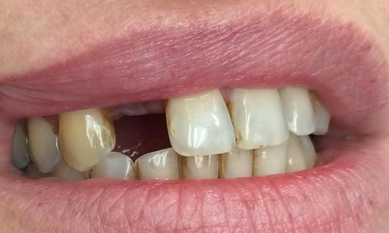 Dental-Implant-Results-Before-Image