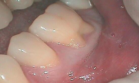 Gum-Recession-Treatment-Before-Image