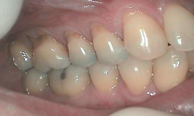 before Gum Recession Treatment in Glendale