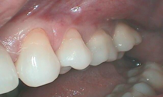 Gum Recession Treatment in Glendale