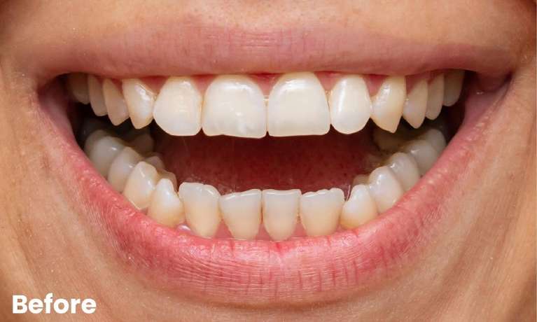Teeth-Whitening-Before-Image